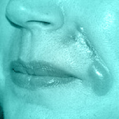 عوارض تزریقات زیبایی